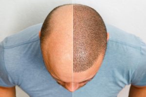 How to get rid of hair loss in men?